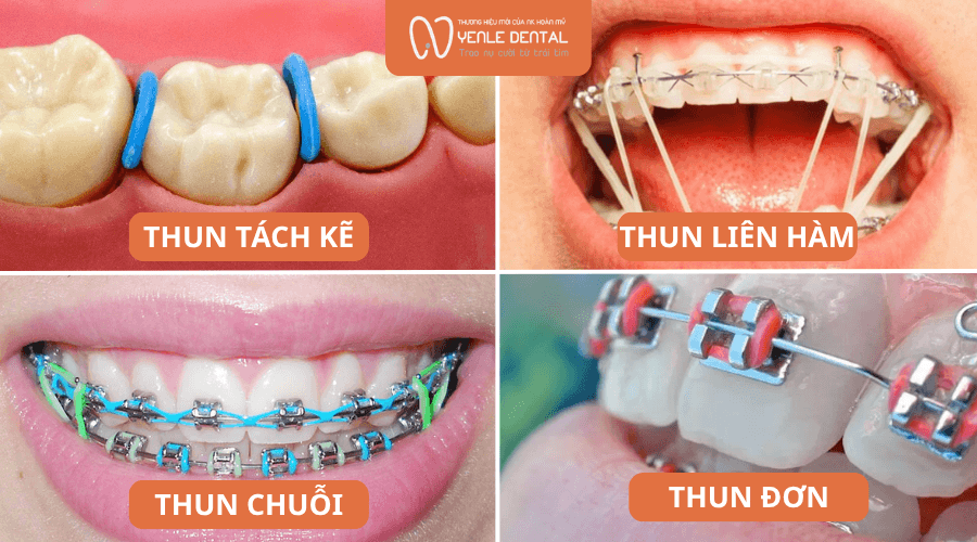 các loại dây thun